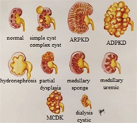 medullary cystic kidney disease.